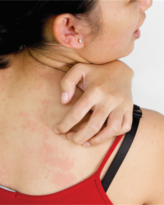 Urticaria Clinical Research Urticaria Clinical Research