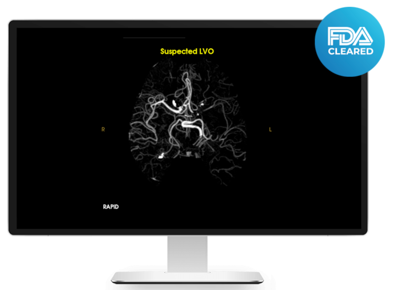 RAPID-AI technology facilitates fast identification of suspected LVOs