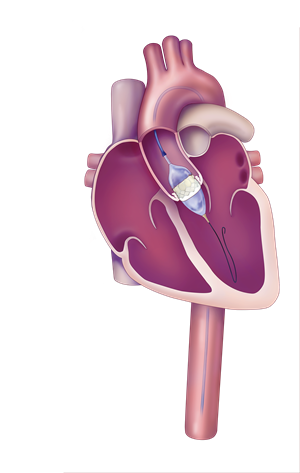 TAVR Device - Step 2